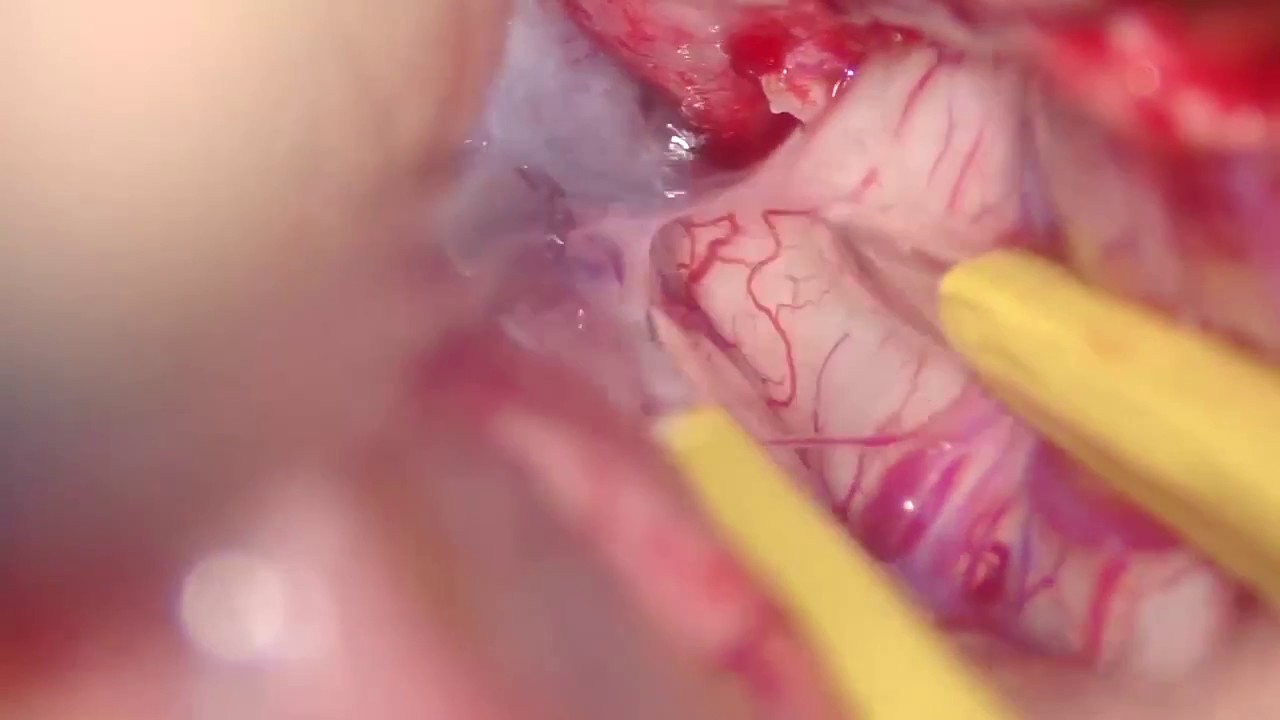 Brain Aneurysm Clipping