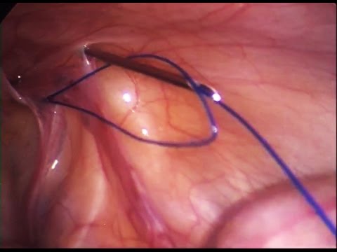 Pediatric inguinal hernia repair - Percutaneous internal ring suturing (PIRS)