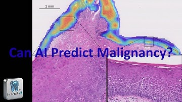 DL for Prediction of Malignant Transformation in Oral Epithelial Dysplasia in Slide Images