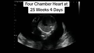 Baby Heartbeat On 2D Ultrasound At 25 Weeks 4 Days Pregnant