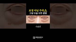 하안검 수술 이렇게까지 잘 될 일?