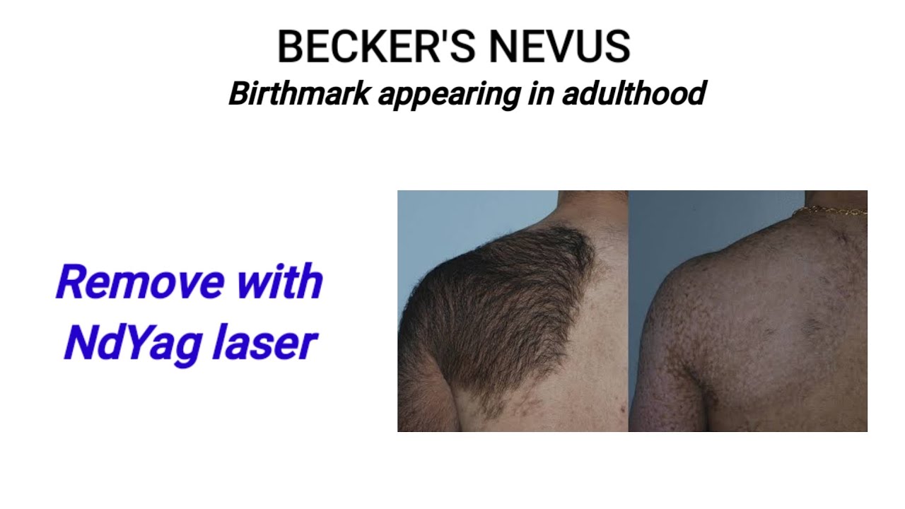 Puberty or Adult Birthmark treatment @DrArifMDDermatologist - YouTube