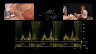 Ischemic Cardiomyopathy: Entire Echo Exam