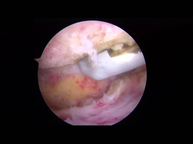 osteoartrite degenerativa acromioclavicular