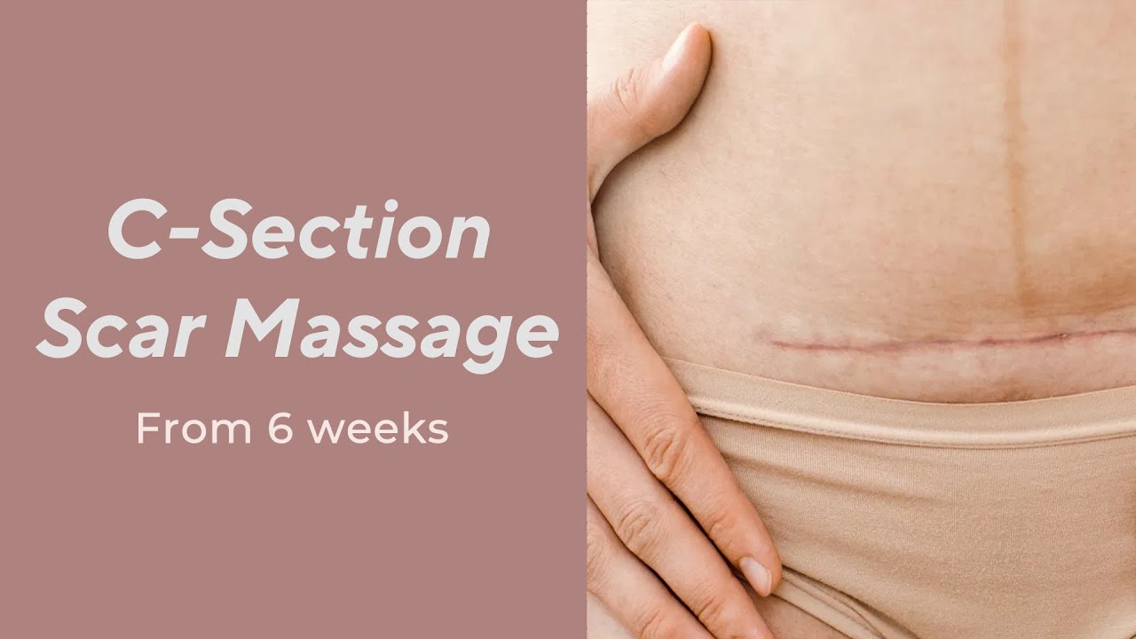 C-Section Scar Massage - From 6 Weeks 