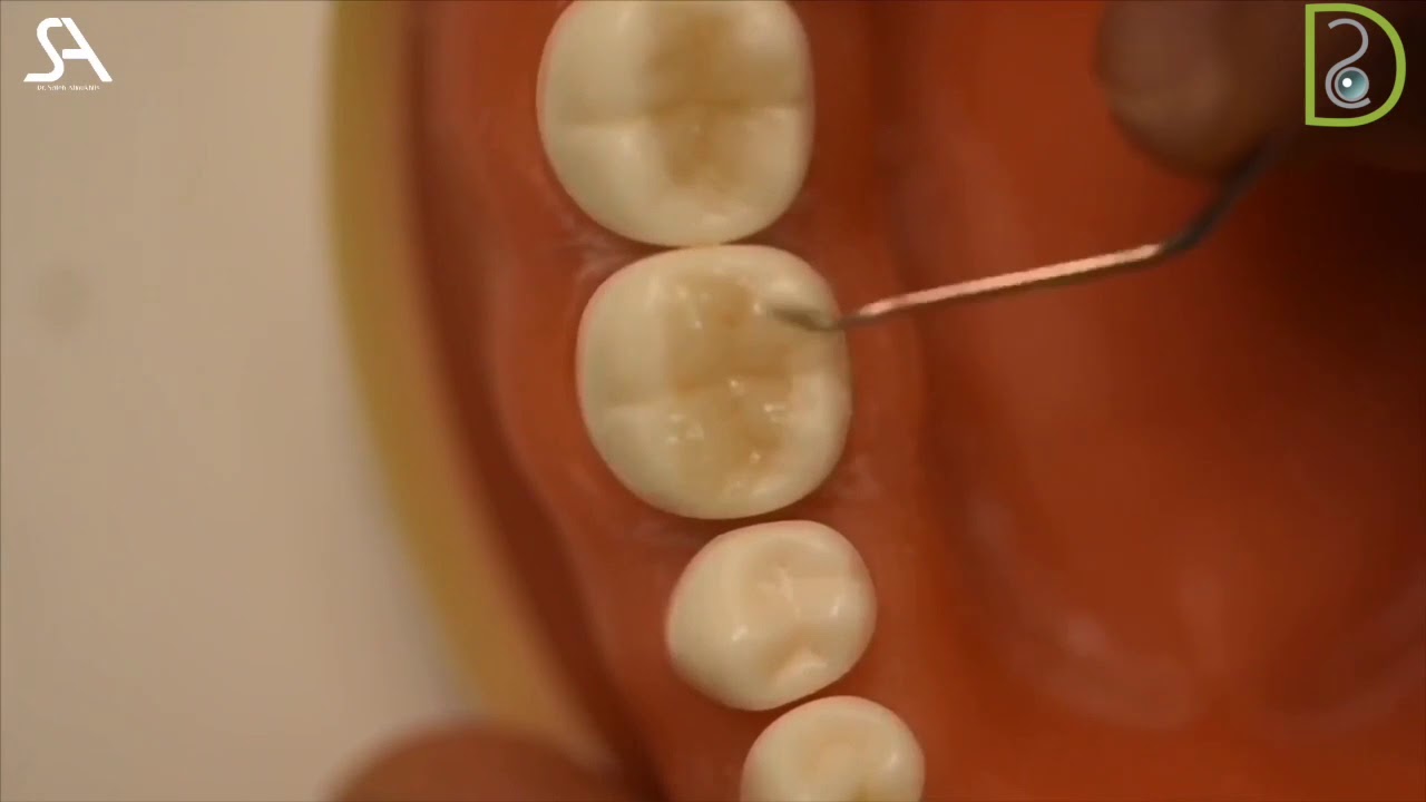 Dentiscope | Class I Composite Restoration Bulk fill technique