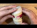 Immediate maxillary denture set up