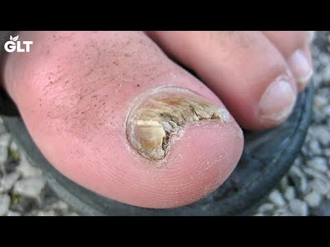5-simple-home-remedies-for-treating-toenail-fungus