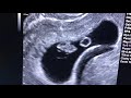 Sonogram 8 weeks pregnant