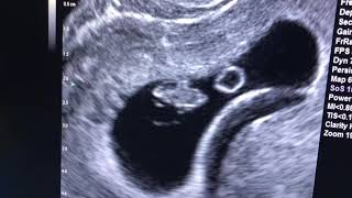 Sonogram: 8 weeks pregnant!