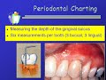 Charting Sequence and Periodontal Charting