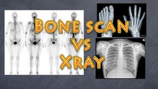 How are bone scans related to x-rays