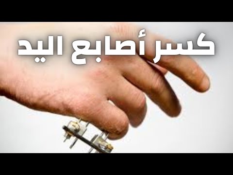 علامات كسر الاصبع وعلاجه | علامات كسر إصبع اليد | كسر الاصبع في اليد | التئام العظام| التئام الكسور