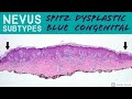 Spitz Nevus, Dysplastic Nevus, Blue Nevus, Congenital Nevus & more - Dermatopathology Basics