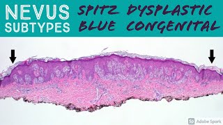 Spitz Nevus, Dysplastic Nevus, Blue Nevus, Congenital Nevus & more - Dermatopathology Basics