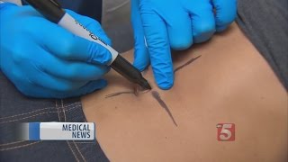 Doctor Discusses Turning An Outie Belly Button Into An Innie Doctor Discusses Turning An Outie Belly Button Into An Innie