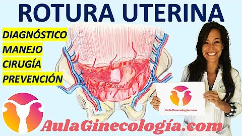 ¿La rotura uterina provoca la muerte fetal?