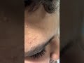 Skincare satisfying videos #pimples #pimplepopping #acne #remove #hairremoval #trending #blackheads