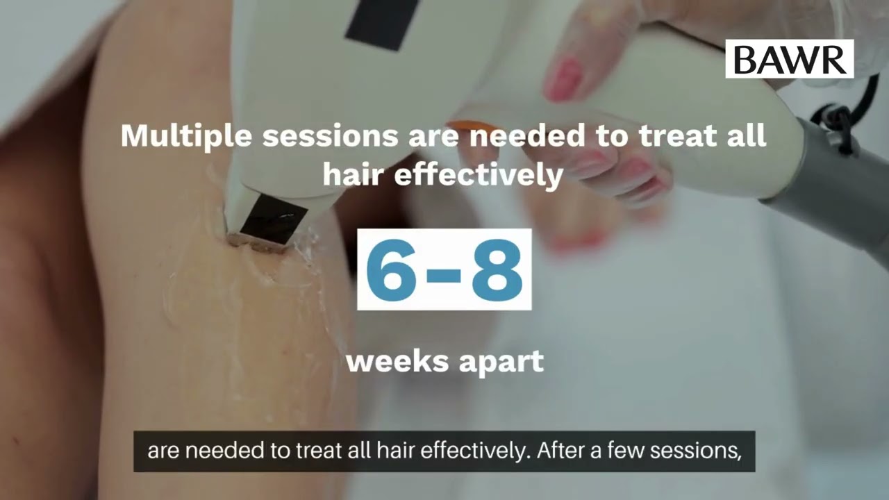 Laser Hair Removal in Dallas, TX | Smooth Skin Duration Tips