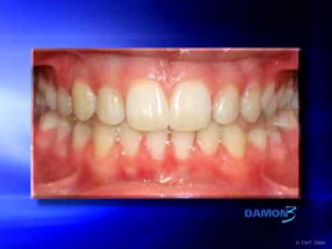 Damon Braces System Lubbock Tx Orthodontist