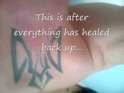 Tattoo Removal 2 Before And After DIY - YouTube