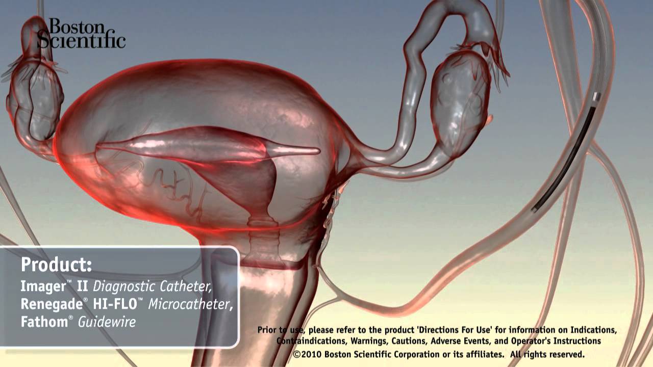 varicele vaselor uterine
