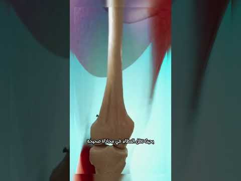 ما هو الكسر المركب شاهد كيف يتم علاجه 