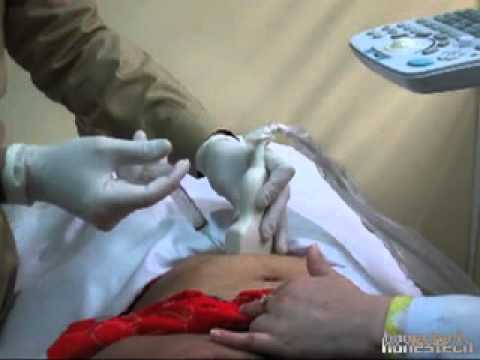 chorionic villus sampling