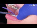 Braces Check up - Changing Power Chains - Tooth Time New Braunfels