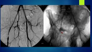 Turbohawk Atherectomy - Why, When, and How? - Khusrow Niazi, MD