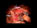 Robotic Assisted Sleeve Gastrectomy