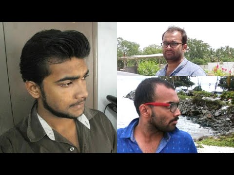 balding-in-my-20's-in-india-🇮🇳-dealing-with-balding-as-an-indian-man