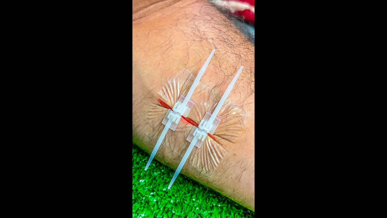 Essa abraçadeira de emergência FECHA qualquer CORTE em 5 segundos! 🤐🤕