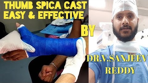 Applying thumb Spica cast for Scaphoid fracture| Fibreglass casting technique