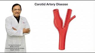 Celebrity Carotid Artery DIsease - Episode 2 - Pattern Recognition. Profile