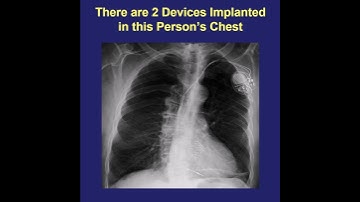 TAVR and Pacemaker - why sometimes both?