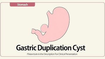 Gastric Duplication Cyst and Its Management ( in the video description).