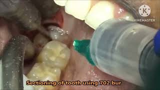 Horizontal impaction wisdom teeth removal(3 cases )خلع ضرس العقل المدفون