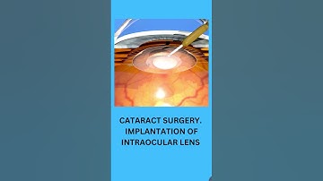 Eye Surgery for Lens Replacement 👁️ #shorts #lens #surgeryasmr
