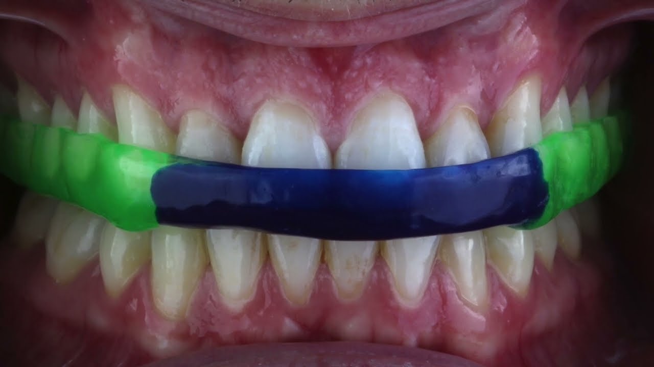 Método de confecção de placa oclusal em resina autopolimerizável