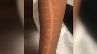 How to cover car accident scar- Basma Hameed Clinic