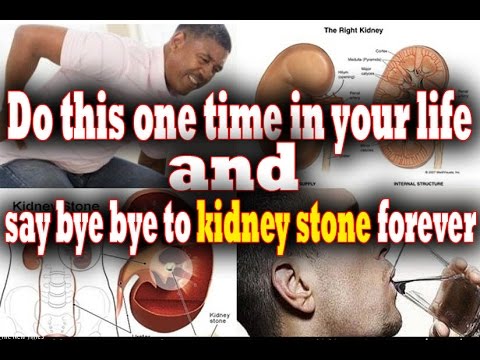 how-to-get-rid-of-kidney-stone
