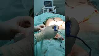 شد البطن كاملة لايف / عملية شد ترهلات البطن / شفط دهون البطن / Abdominoplasty/ Tummy tuck