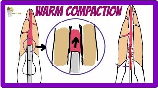 ENDODONTICS | OBTURATION TECHNIQUES | Warm Vertical Compaction technique