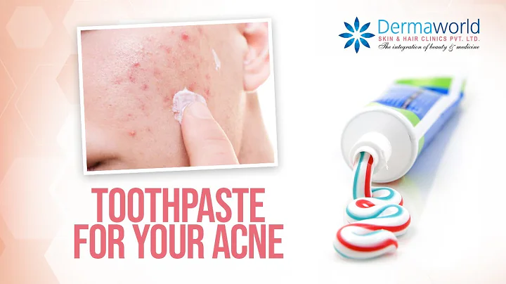 Toothpaste for acne/pimples ? Dr. Rohit Batra explains the effects  #acnetreatment #HowToRemoveAcne