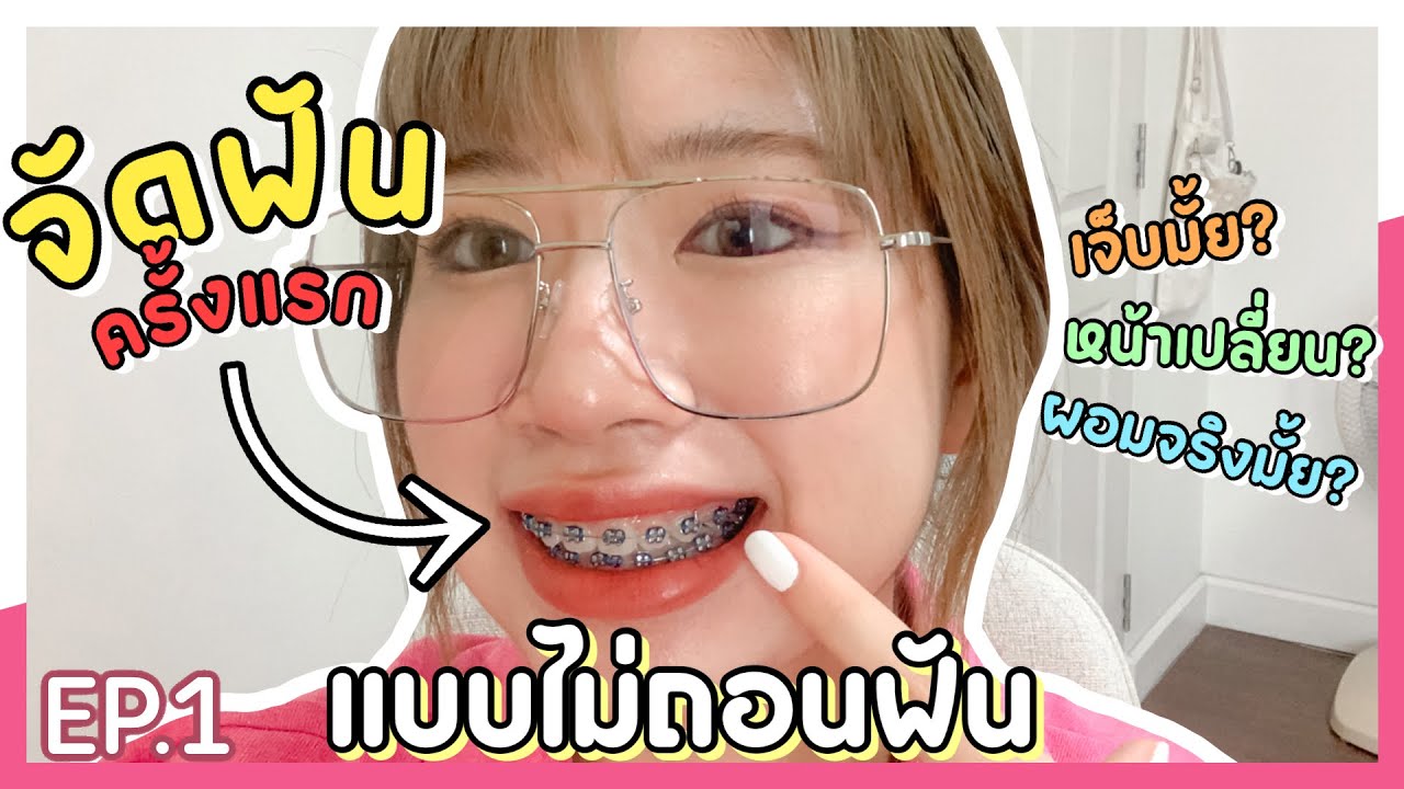 จัดฟันครั้งแรก!! แบบไม่ถอนฟัน หน้าเปลี่ยน? ผอมมั้ย? เจ็บอะเป่า? EP.1(มีต่อ) | SOMz