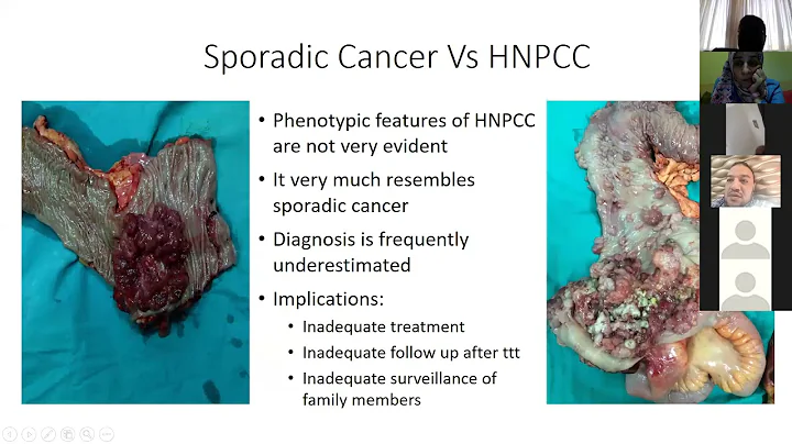 prof. Ahmed AbdelAziz , , Colorectal cancer, lynch...