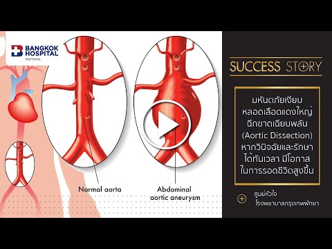 Critical Care มหันตภัยเงียบ หลอดเลือดแดงใหญ่ฉีกขาดเฉียบพลัน (Aortic Dissection) #shorts