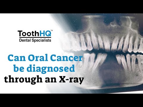 Wideo: Czy rak jamy ustnej pojawiłby się na zdjęciu rentgenowskim?