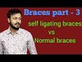 Self ligating braces vs normal braces |Damon system braces | Orthodontist | traditional braces hindi